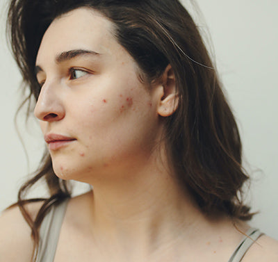 Acne: Everything you need to know