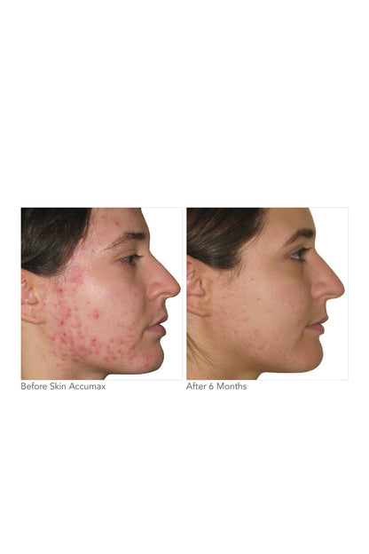 Skin Accumax